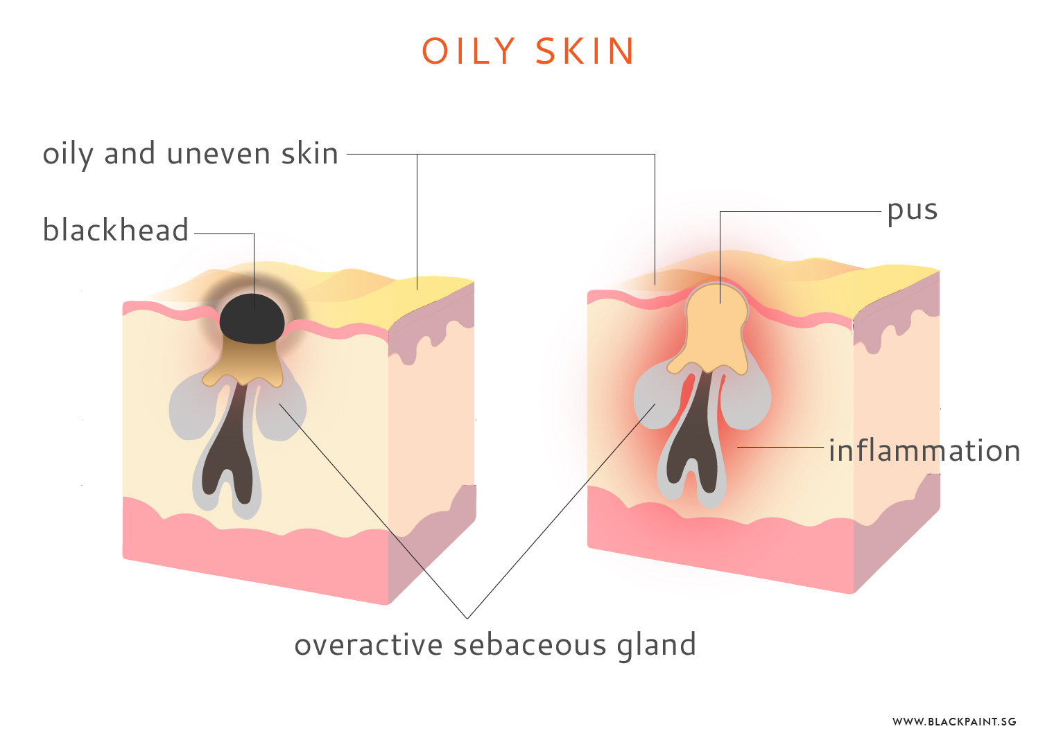 Oily skin cross section