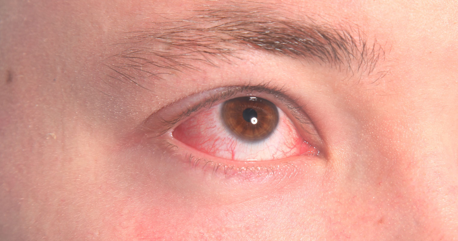 dry eyes or eye irritation caused by rosacea