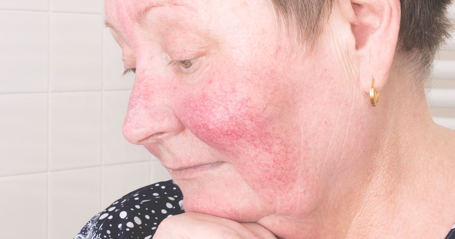 woman with rosacea symptoms on her face