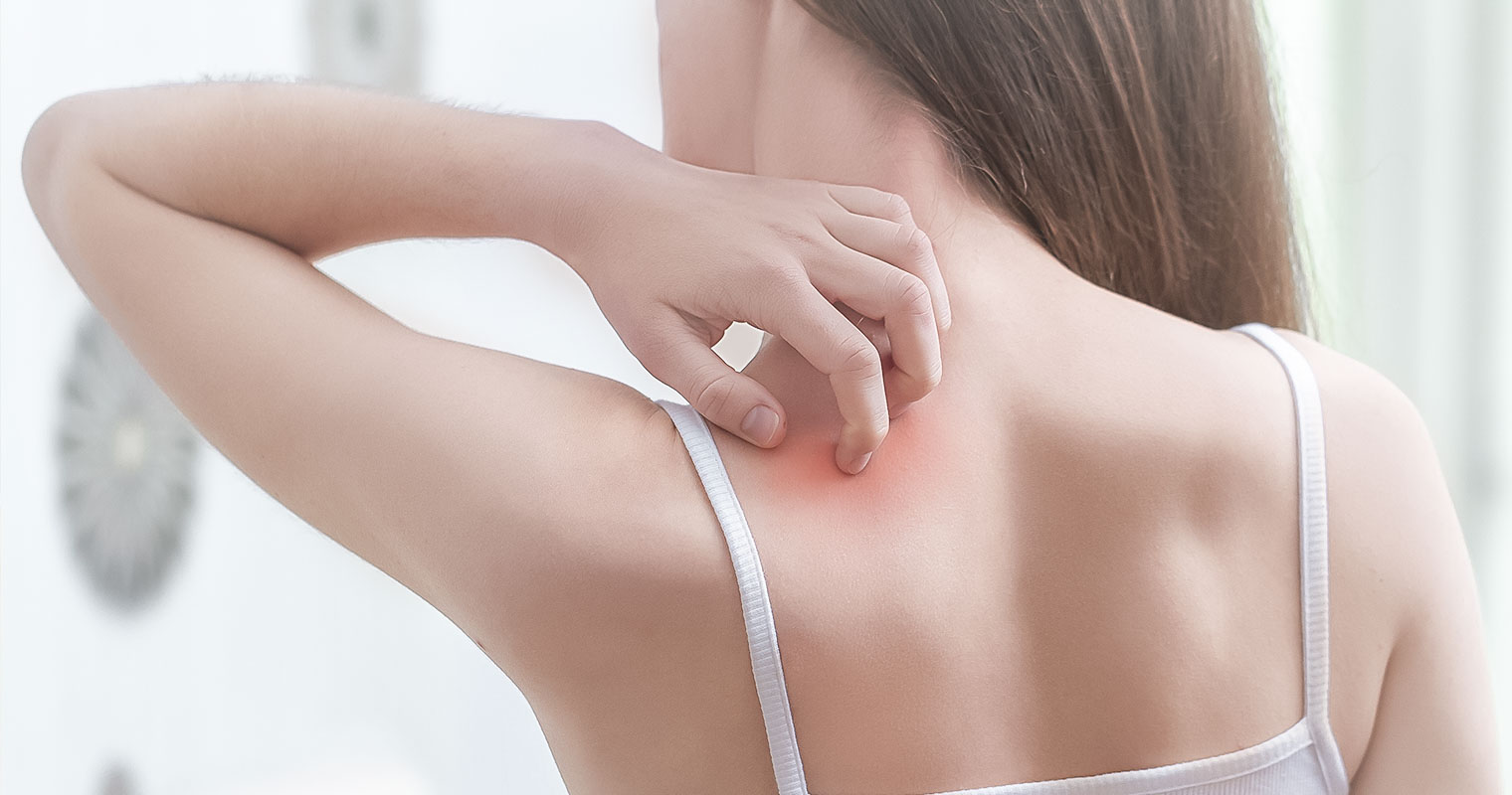 Woman scratching the back of her shoulder with heat rash