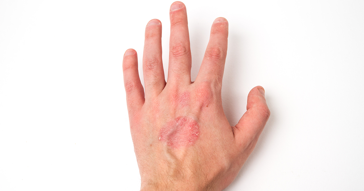 psoriasis on the back of the hand