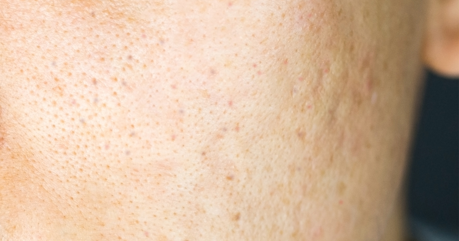 uneven skin texture is a characteristic of bad skin